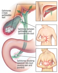 Galstones complications,Gallstones image,gallstones,inflammation of gallbladder image,inflammation of gallbladder ,Blockage of the common bile duct,Blockage of the pancreatic duct image,